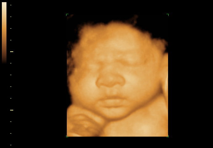 3D ultrasound image at 36 weeks